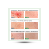 Teashell Acne Clearing & Oil-Control Serum Ampoules – AHA + PHA + BHA, 1.5ml x 5